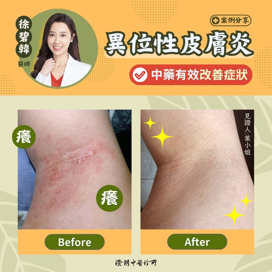 250328_atopic dermatitis_case_dr.Hsu 250328_atopic dermatitis_case_dr.Hsu
